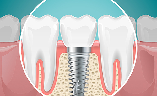 servicio-implantes-belen-villacastin-clinica-dental